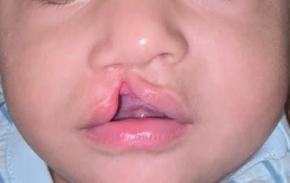 Cleft Lip & Palate Surgery — visual context