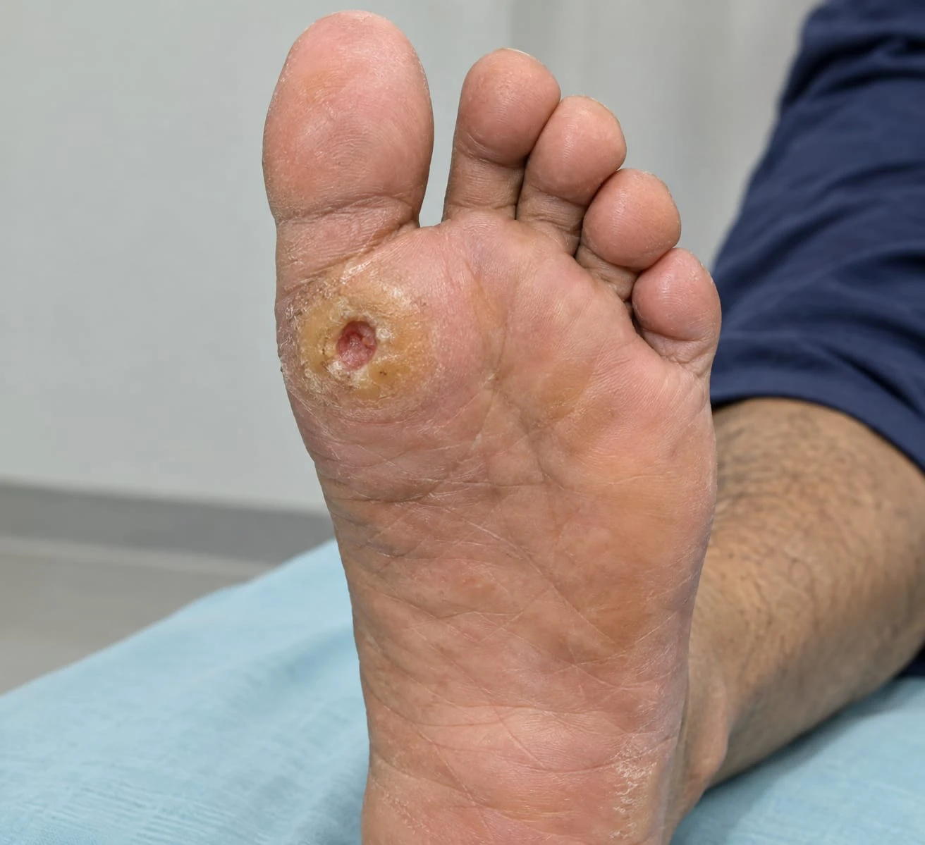 Diabetic Foot Surgery — visual context